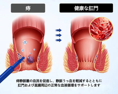 CleraNature® ProctoEase 鎮静痔瘡護理凝膠🌿
