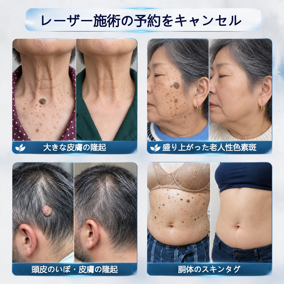 CleraNaure® 肌凹凸リファインクリーム｜気になる肌の盛り上がり・ほくろ・シミにアプローチ 刺激の少ない自宅スキンケアクリーム