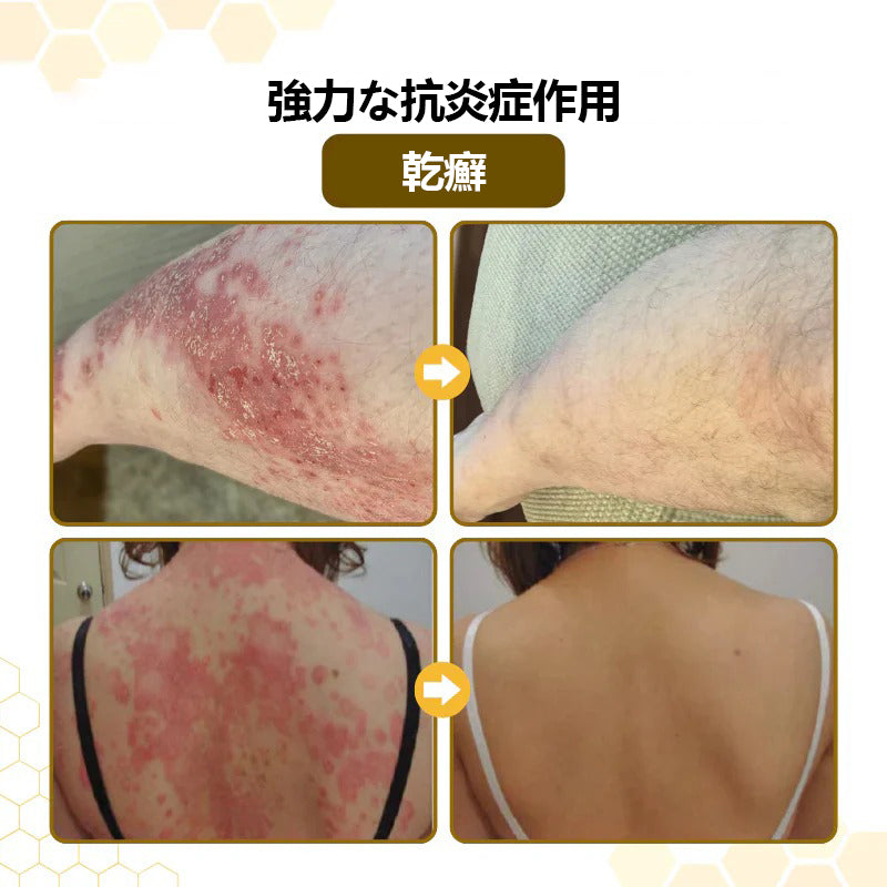 🐝CleraNature® PsoriaSoothe 蜂毒配合スキンリジェネレーティングクリーム