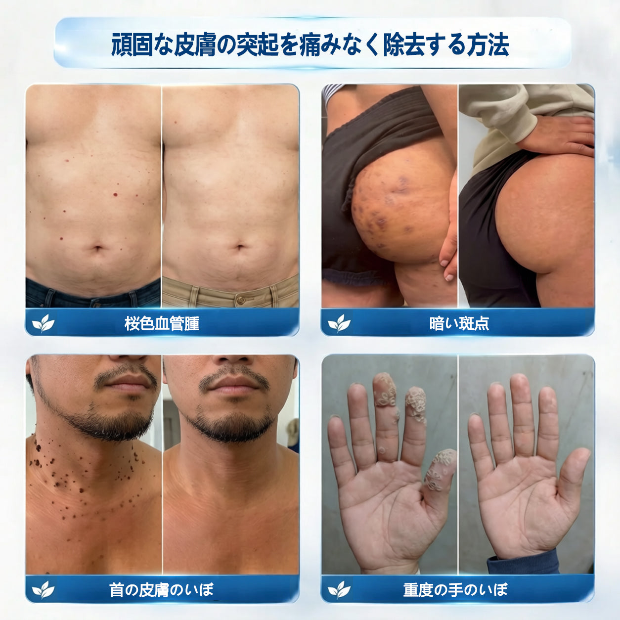 公式ストア🎉7 日間ピンポイントケアローラー 痛みなし・傷跡残らないタイプ