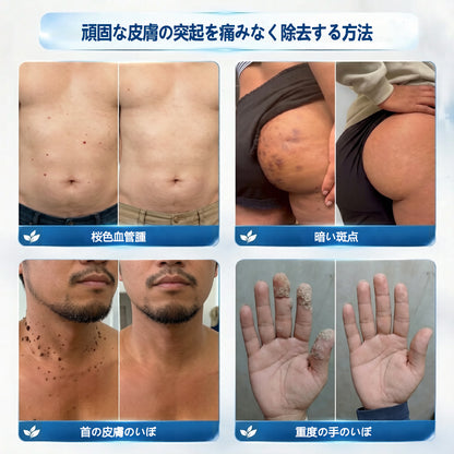 公式ストア🎉7 日間ピンポイントケアローラー 痛みなし・傷跡残らないタイプ