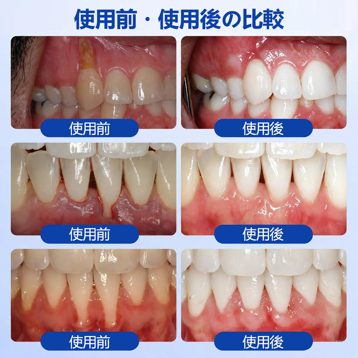CleraNaure® GumRevive 歯周組織修復ジェル