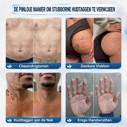CleraNaure® 肌凹凸リファインクリーム｜気になる肌の盛り上がり・ほくろ・シミにアプローチ 刺激の少ない自宅スキンケアクリーム