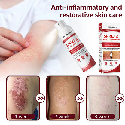 CleraNature® Beef Tallow Spray na svrbiacu, olupujúcu pokožku pri psoriáze