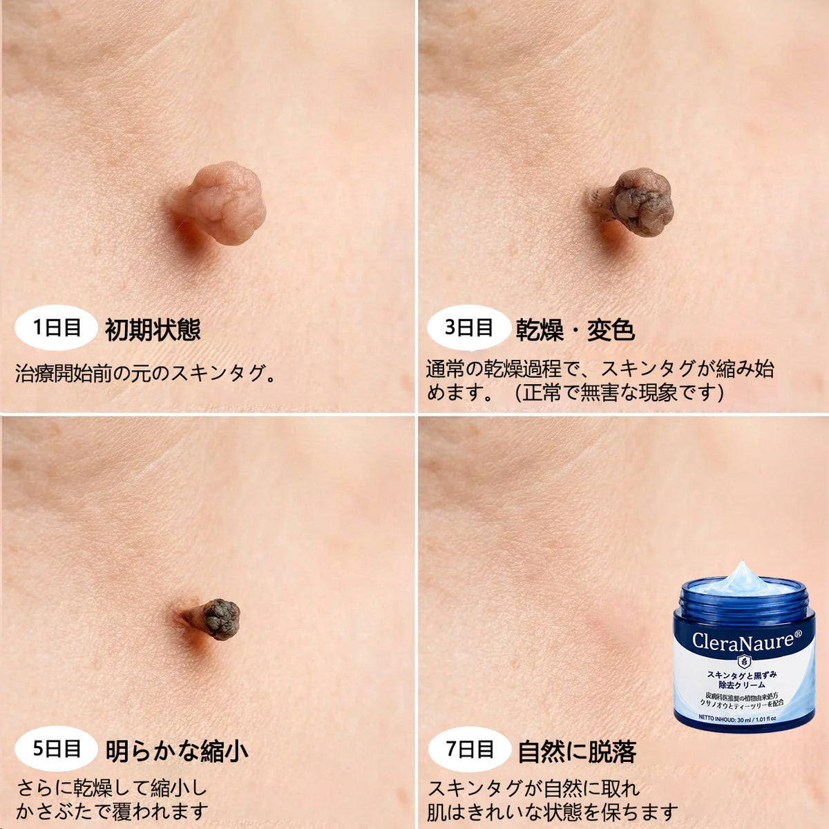 CleraNaure® 肌凹凸リファインクリーム｜気になる肌の盛り上がり・ほくろ・シミにアプローチ 刺激の少ない自宅スキンケアクリーム
