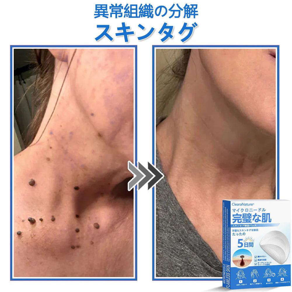 🔥ClearaNature® 2in1 マイクロニードルハイドロコロイドパッチ イボ・ほくろ・ニキビケア シワ・傷跡・肌荒れ改善 顔＆全身用目立たないケアパッチ