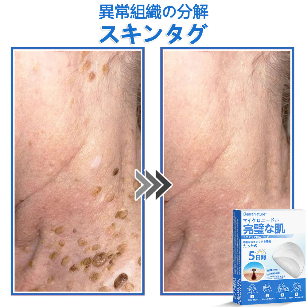 🔥ClearaNature® 2in1 マイクロニードルハイドロコロイドパッチ イボ・ほくろ・ニキビケア シワ・傷跡・肌荒れ改善 顔＆全身用目立たないケアパッチ